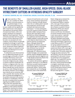The Benefits of Smaller-Gauge, High-Speed, Dual-Blade Vitrectomy Cutters in Vitreous Opacity Surgery.pdf