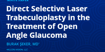 Direct Selective Laser Trabeculoplasty in the Treatment of Open Angle Glaucoma